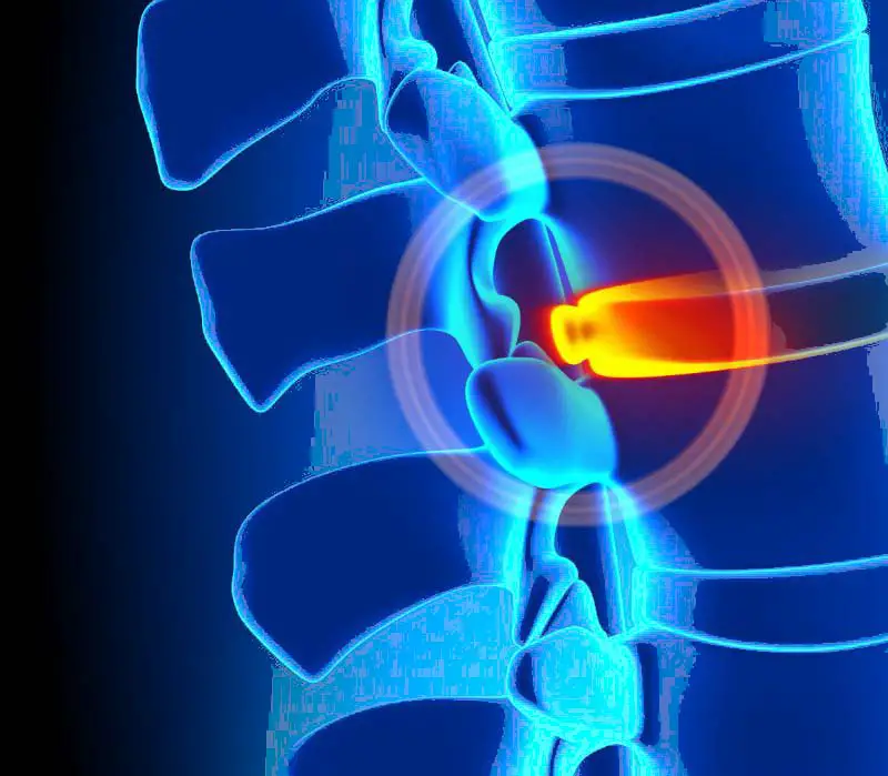 What Is Disc Herniation